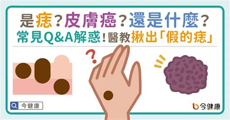 會長大的痣|是痣？皮膚癌？還是什麼？常見Q&A解惑！醫教揪出「假的痣」